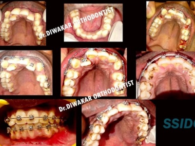 orthodontic crowding correction