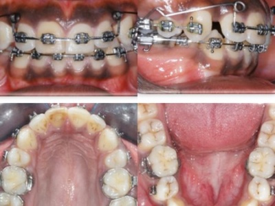pre molar extraction 2