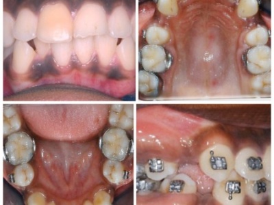 premolar extraction 1