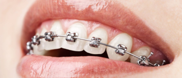 dental-brace-3