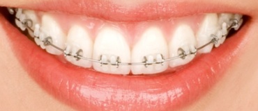 dental-brace-4