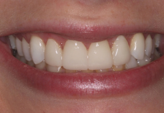 Cosmetic Dentistry – (Smile Line Estheteics)